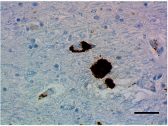 Immunohistochemistry staining of Parkin in Parkinson’s disease brain tissue